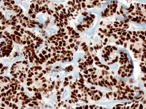 &Ouml;strogenkernrezeptorpositives Mammakarzinom